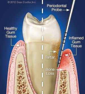 Periodontal Disease.